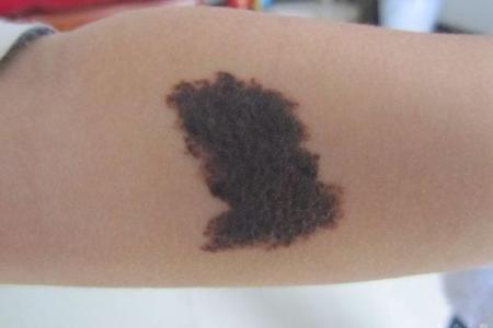 揭秘右手臂长痣的命运象征，带你了解你的个性与未来！