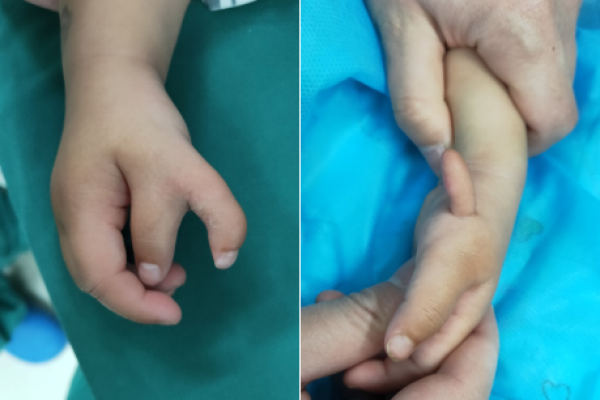 手指短细小的命运:如何看待和调整自己的生活轨迹 手指短细小的命运:如何看待和调整自己的生活轨迹