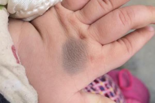 手背胎记的命运解析：探寻你的命中注定