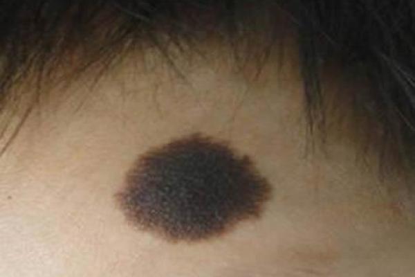 手背胎记暗示的命运秘密:你的未来由此揭示! 手背胎记暗示的命运秘密:你的未来由此揭示!