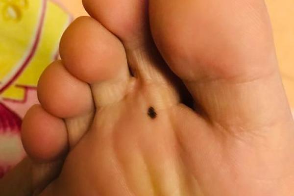 男人右脚脚底的痣：神秘命理与生活影响解析