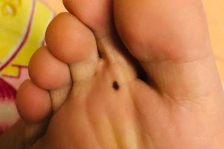 男人右脚脚底的痣：神秘命理与生活影响解析