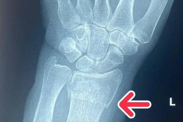 手腕两根细骨头的命运解读:为何它们与我们的生活息息相关 手腕两根细骨头的命运解读:为何它们与我们的生活息息相关