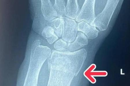 手腕两根细骨头的命运解读：为何它们与我们的生活息息相关