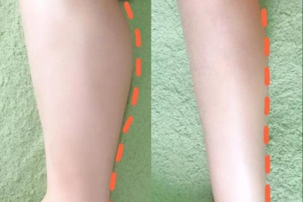 手腿细身体胖,命运与特征的深度解析 手腿细身体胖,命运与特征的深度解析