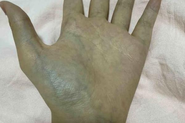 手相中血管青紫的秘密:揭示命运的隐秘密码 手相中血管青紫的秘密:揭示命运的隐秘密码