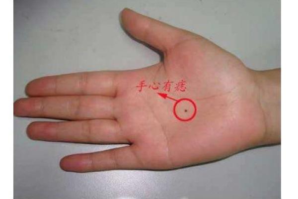 手心有痣的女人:命理解析与运势揭秘! 手心有痣的女人:命理解析与运势揭秘!