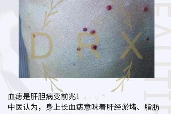 前胸后背长红痣，揭示你命运的秘密