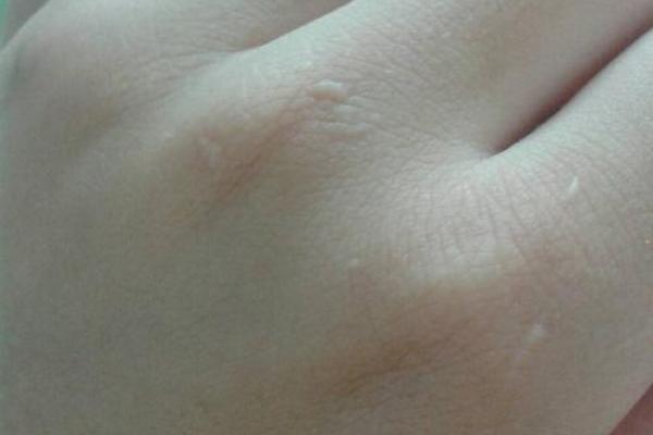 手上有疤之命格解析:疤痕背后的命运玄机 手上有疤之命格解析:疤痕背后的命运玄机