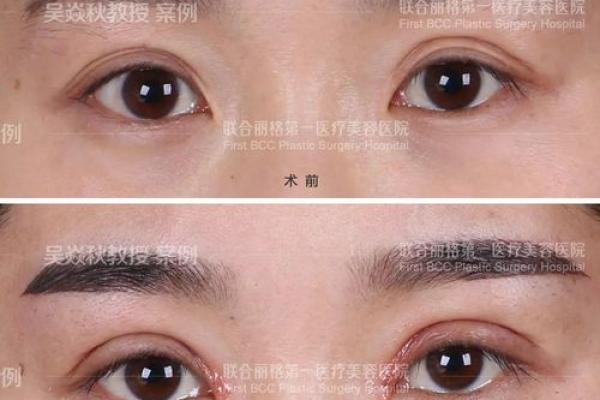 解析男士眼皮纹理:从男三眼皮看命理与性格特征 解析男士眼皮纹理:从男三眼皮看命理与性格特征