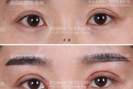 解析男士眼皮纹理：从男三眼皮看命理与性格特征