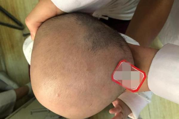 生殖有胎记:揭示命运背后的神秘与启示 生殖有胎记:揭示命运背后的神秘与启示