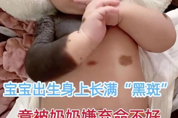 生殖有胎记:揭示命运背后的神秘与启示 生殖有胎记:揭示命运背后的神秘与启示